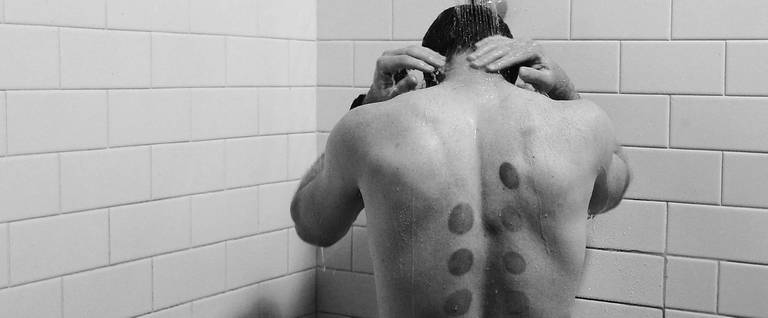 Cupping marks are seen on the back of Jack Johnson of the Magpies on September 20, 2014 in Hastings, Australia. 
