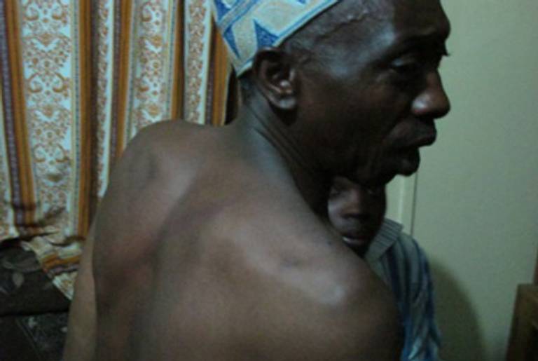 supporter of Rabbi Gershom Sizomu shows bruise marks on election night, February 18, 2011, Nabugoye, Uganda.(The author)